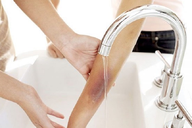 Bỏ túi ngay cách phân độ bỏng, xử trí và làm mờ sẹo sau bỏng