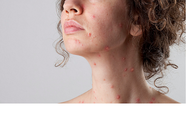 Đâu là cách chữa bệnh thủy đậu nhanh nhất và không để lại sẹo?