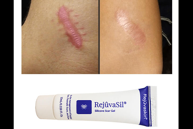 Sử dụng Gel làm mờ sẹo Scar Rejuvasil đúng cách- Yếu tố chính đảm bảo tốt nhất hiệu quả