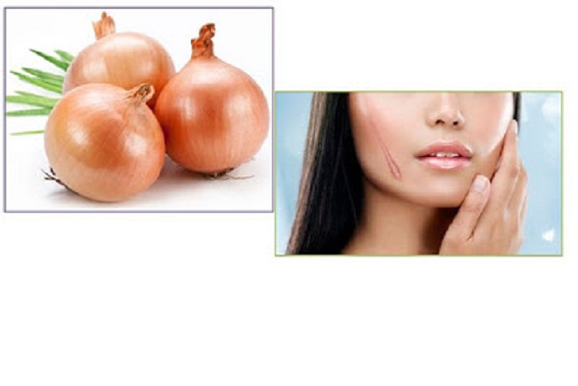 Mách bạn cách làm mờ sẹo lồi bằng hành tây hiệu quả bất ngờ