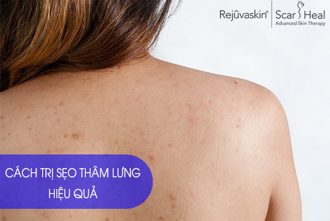 Bật Mí Top 2 Cách Làm Mờ SẹoThâm Ở Lưng Cấp Tốc