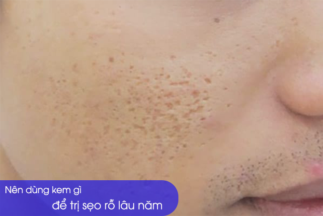 Bạn đã tìm ra đâu loại kem làm mờ sẹo rỗ, lõm lâu năm hiệu quả nhất hiện nay chưa?