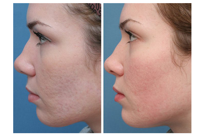 Kem làm mờ sẹo lõm lâu năm nào luôn được các chuyên gia da liễu khuyên dùng?