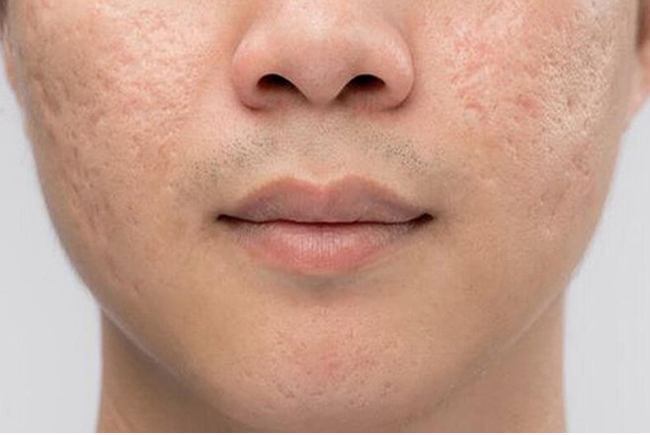 95% mụn trứng cá để lại sẹo rỗ 