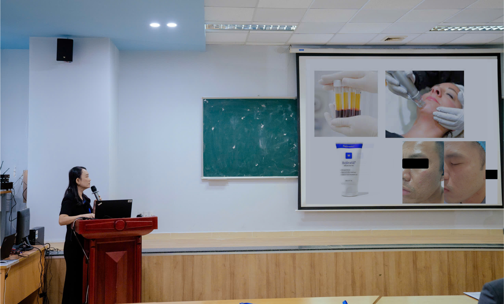 Ứng dụng RF vi kim trong làm mờ sẹo lõm