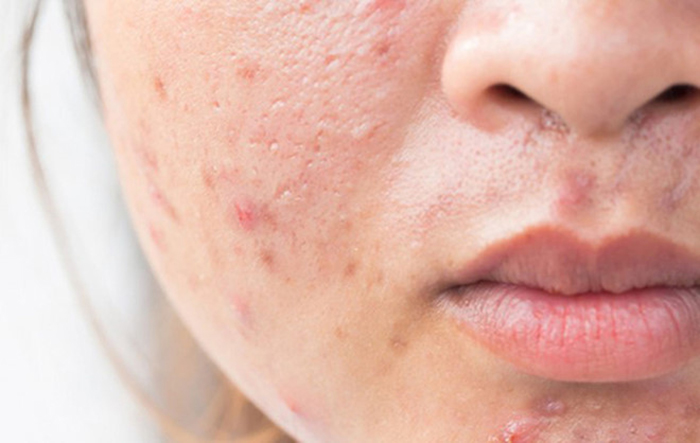 Sẹo rỗ do mụn trứng cá để lại