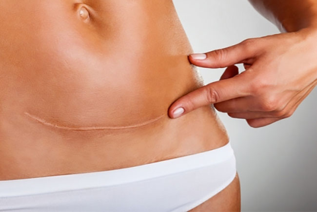 Sẹo mổ đẻ, có nên dùng kem làm mờ sẹo không? Nên mua loại nào tốt nhất?