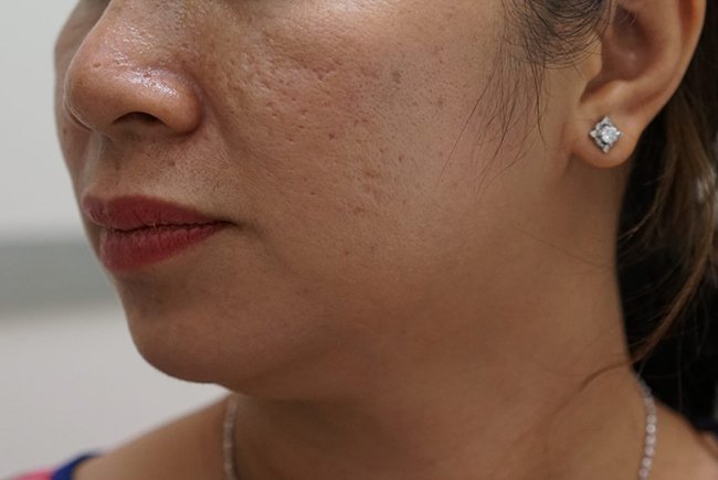 “Học lỏm” 5 cách làm mờ sẹo lõm đã được “hội chị em” công nhận