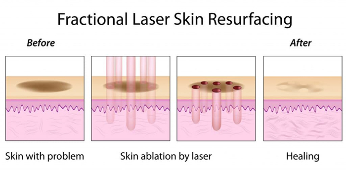 Làm mờ sẹo rỗ bằng công nghệ Laser CO2 Fractional
