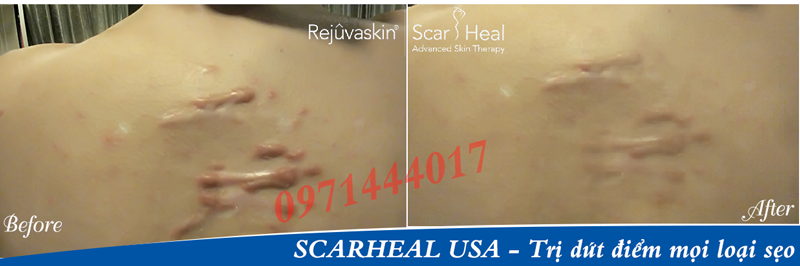 kem làm mờ sẹo lồi scar rejuvasil