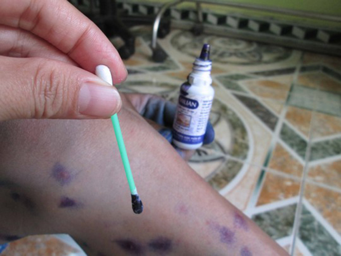 Bôi thuốc xanh lên các nốt đậu đã bị dập vỡ ra Bôi thuốc xanh lên các nốt đậu đã bị dập vỡ ra