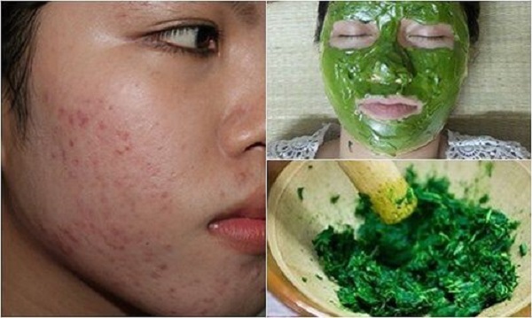 Phương pháp làm mờ sẹo rỗ tại nhà bằng rau má