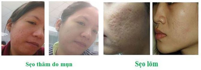 Sự xuất hiện của Scar Esthetique đã giúp chị em tự tin trở lại, không còn lo ngại sẹo thâm, rỗ, lõm làm ảnh hưởng Sự xuất hiện của Scar Esthetique đã giúp chị em tự tin trở lại, không còn lo ngại sẹo thâm, rỗ, lõm làm ảnh hưởng