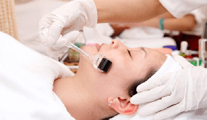 Công nghệ lăn kim làm mờ sẹo rỗ Công nghệ lăn kim làm mờ sẹo rỗ