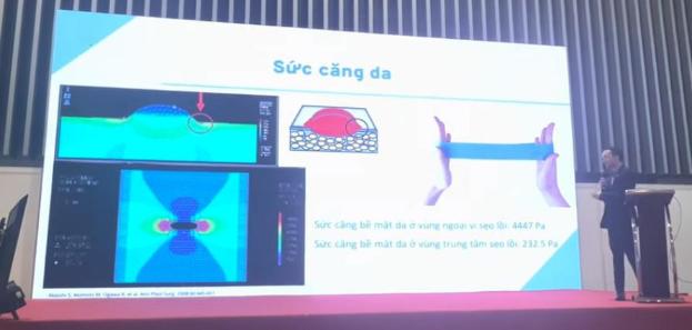 Các yếu tố nguy cơ và vị trí thường xuất hiện sẹo lồi, sẹo phì đại