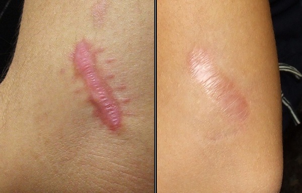 Gel làm mờ sẹo giúp điều trị các vết sẹo lỗi, sẹo thâm, sẹo phẫu thuật hiệu quả    Gel làm mờ sẹo giúp điều trị các vết sẹo lỗi, sẹo thâm, sẹo phẫu thuật hiệu quả