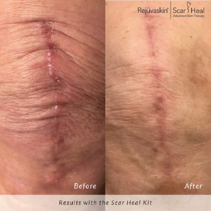 Hình ảnh hiệu quả sau khi sử dụng gel làm mờ sẹo Rejuvaskin và miếng dán Scar FX do khách hàng cung cấp