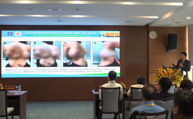 Bác sĩ đặt túi căng giãn da trong điều trị bớt sắc tố khổng lồ