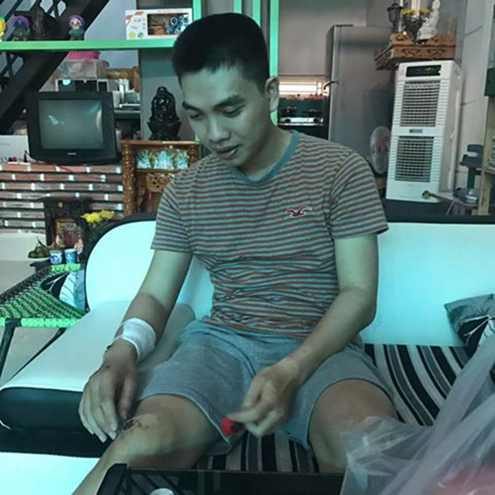 Những vết sẹo xuất hiện trên khắp cơ thể chàng trai thư sinh trẻ tuổi Nguyễn Lê Hoài Nam sau tai nạn Những vết sẹo xuất hiện trên khắp cơ thể chàng trai thư sinh trẻ tuổi Nguyễn Lê Hoài Nam sau tai nạn