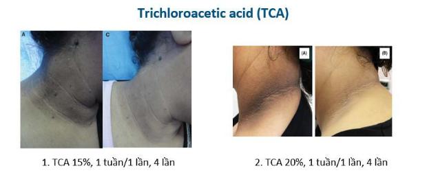 Tái tạo da bằng hóa chất trong điều trị làm sáng vùng da nhạy cảm