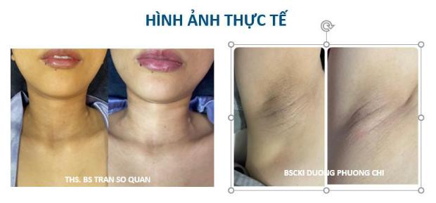 làm sáng da vùng nhạy cảm trên cơ thể