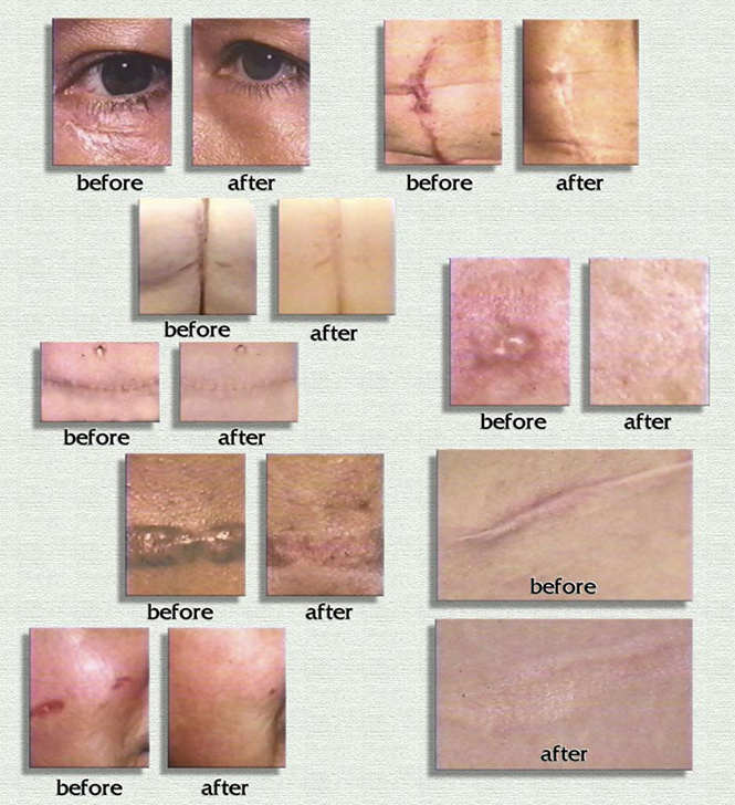Trước và sau khi sử dụng gel làm mờ sẹo Scar Rejuvasil    Trước và sau khi sử dụng gel làm mờ sẹo Scar Rejuvasil