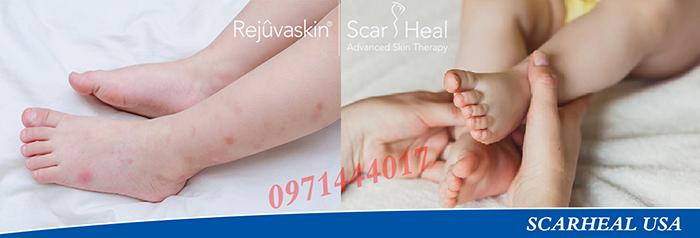 Sẹo do côn trùng cắn chỉ cần 3 tuýp kem đã bị xóa bỏ hoàn toàn