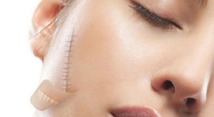 Sẹo được hình thành do quá trình