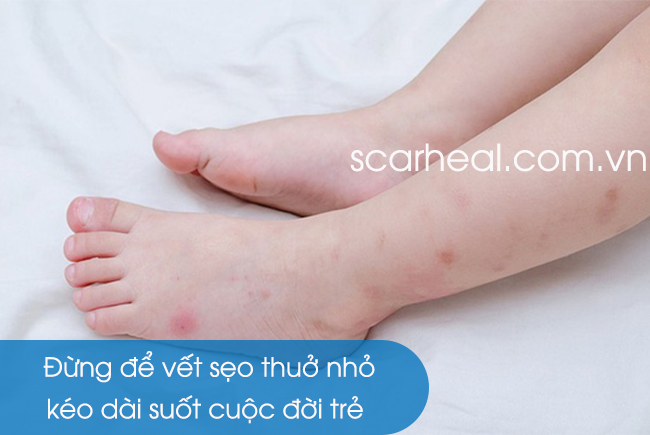 làm mờ sẹo thâm cho trẻ