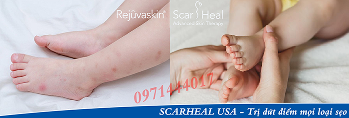 Scar Esthetique còn dùng được cho cả làn da trẻ em. Sẹo do côn trùng cắn chỉ cần 3 tuýp kem đã bị xóa bỏ hoàn toàn