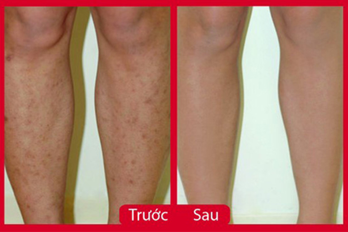 Làm mờ sẹo thâm ở chân chưa bao giờ lại dễ dàng đến thế, bạn đã thử chưa? Làm mờ sẹo thâm ở chân chưa bao giờ lại dễ dàng đến thế, bạn đã thử chưa?