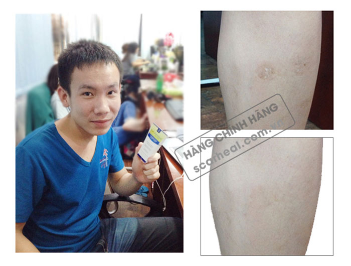 Vết chó cắn của Anh Danh cũng được điều trị như chưa từng xuất hiện Vết chó cắn của Anh Danh cũng được điều trị như chưa từng xuất hiện