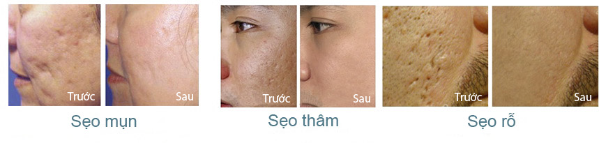  Sản phẩm kem làm mờ sẹo Scar Esthetique hiệu quả tốt với nhiều loại sẹo: sẹo mụn, sẹo thâm, sẹo rỗ