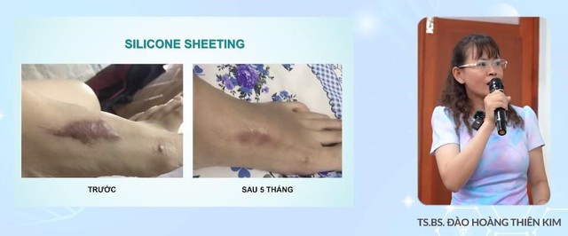 Hướng dẫn sử dụng miếng dán làm mờ sẹo silicone đúng cách