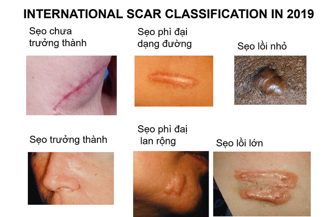 Phân loại sẹo