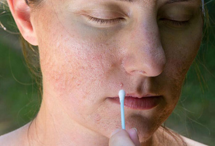 Sẹo là nhân tố gây mất thẩm mỹ ám ảnh nhất đối với phái đẹp