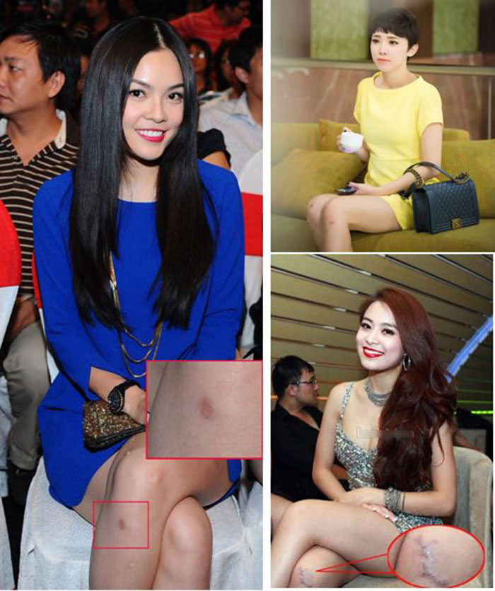 Dù gương mặt hay vóc dáng bạn có xinh đẹp, quyến rũ đến đâu nhưng một khi sẹo đã hiện hữu thì bạn sẽ hoàn toàn bị mất điểm trầm trọng