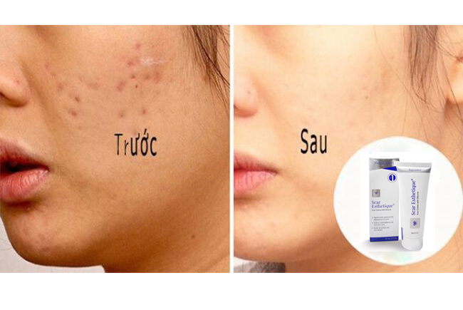  Tiết lộ cách làm mờ sẹo lâu năm hiệu quả mà ít tốn kém nhất