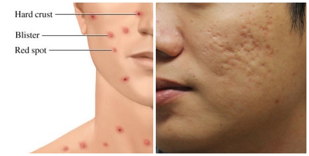 Sẹo lõm gây mất thẫm mỹ làn da trầm trọng