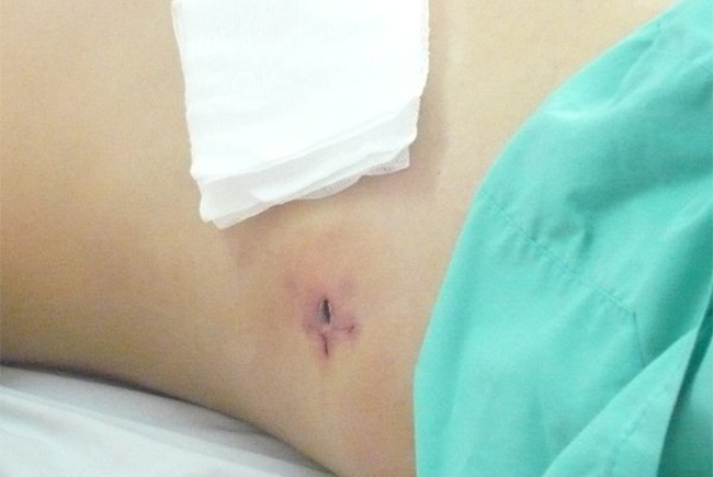 Mổ ruột thừa nên ăn hoa quả gì để cơ thể nhanh chóng hồi phục?