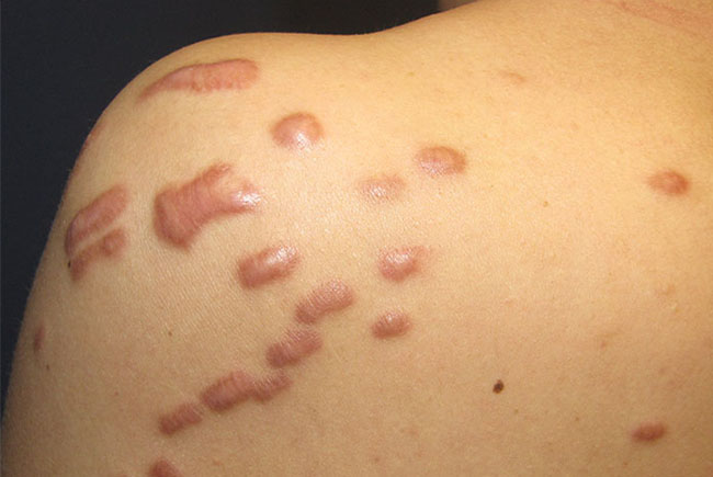 Phân biệt sẹo lồi, sẹo phì đại và cách điều trị hiệu quả nhất