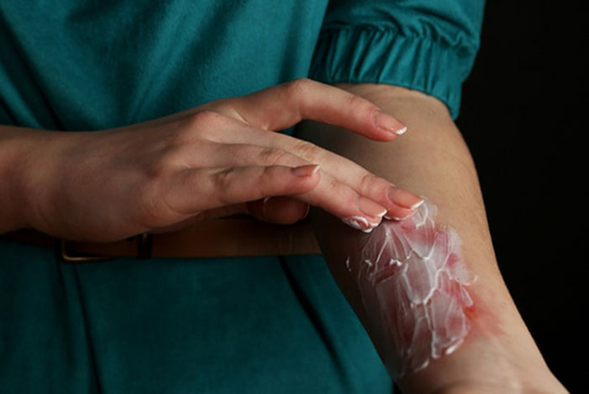 Bí quyết trị bỏng không để lại sẹo bạn cần biết