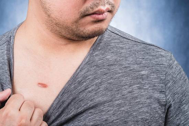 Gel làm mờ sẹo Scar Rejuvasil có an toàn và gây dị ứng không?