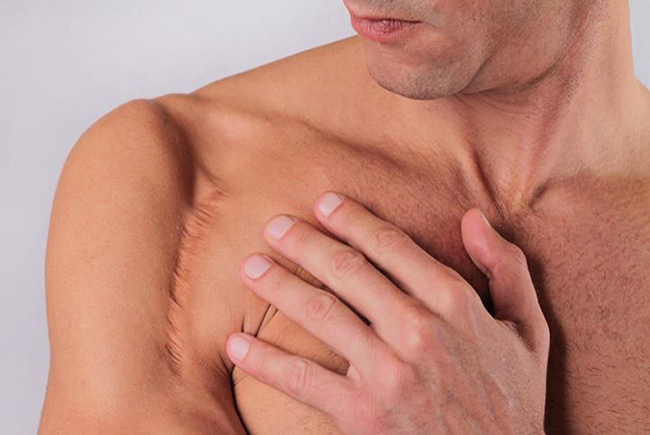 Giá gel làm mờ sẹo Rejuvasil Silicone Scar bao nhiêu? Mua chính hãng ở đâu?