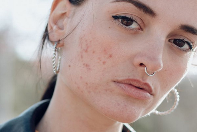 “Bật mí” bí quyết làm cách nào để hết mụn và thâm mụn trứng cá nhanh chóng
