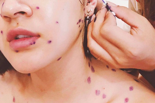 Bệnh thủy đậu có lây không? Làm sao để xua đi hoàn toàn nỗi lo về sẹo?