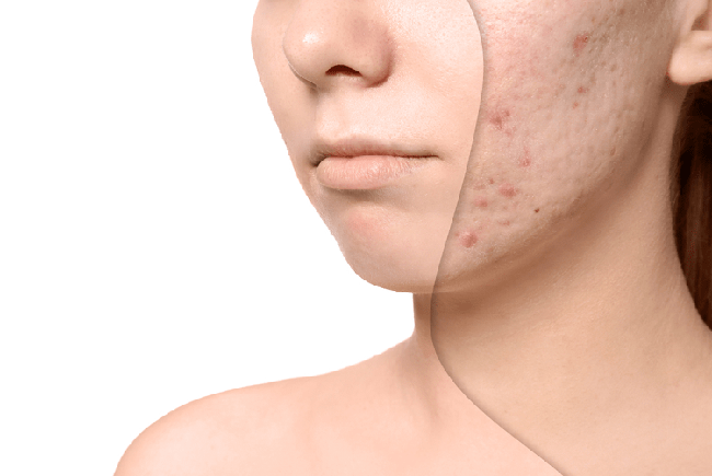 Phương pháp làm mờ sẹo lõm sau mụn hiệu quả, an toàn nhất dành cho tất cả mọi người