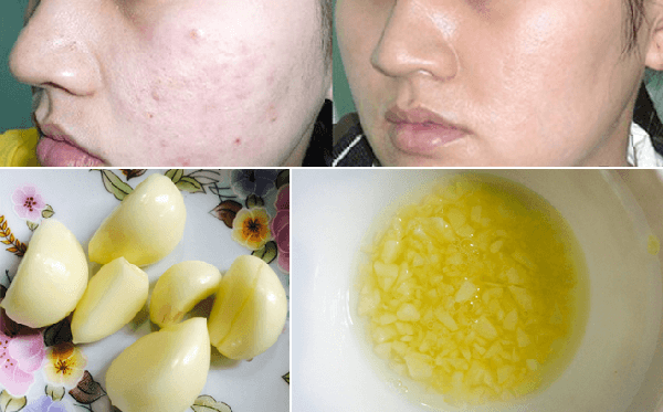 Áp dụng ngay 3 công thức làm mờ sẹo thâm bằng tỏi hiệu quả chỉ sau 1 tuần