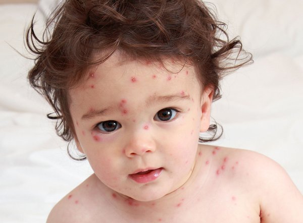 Kem Làm Mờ SẹoThâm Cho Bé An Toàn Và Hiệu Quả Nhất