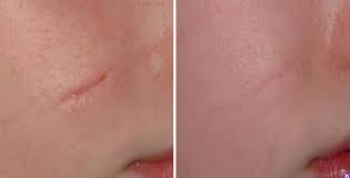 Mang đến hiệu quả cải thiện vết sẹo vượt trội Mang đến hiệu quả cải thiện vết sẹo vượt trội